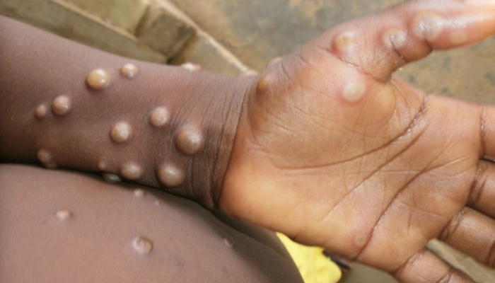Ghana records first case of MPOX in Western North Region